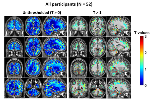 alcohol brain changes