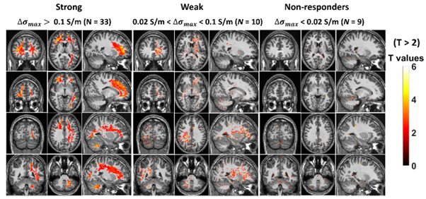 alcohol brain changes