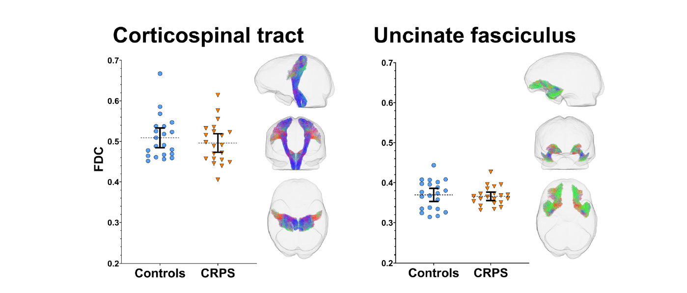 CRPS pain diffusion