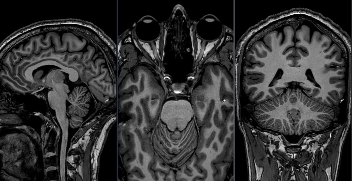 3T MRI PRECISE Philips