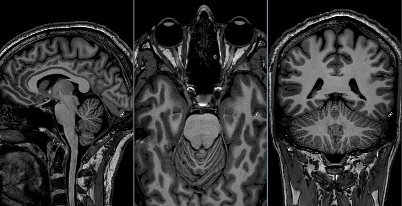 3T MRI PRECISE Philips