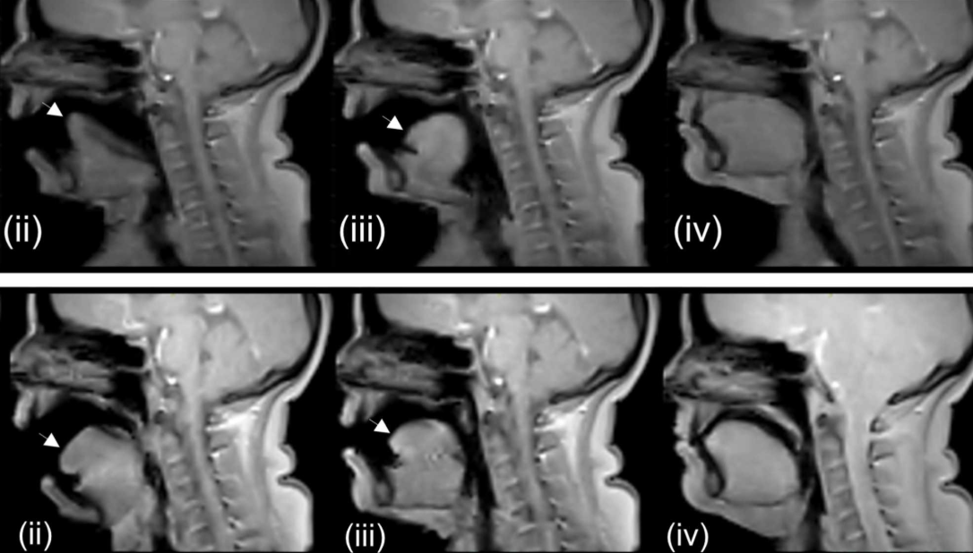 Yawn MRI