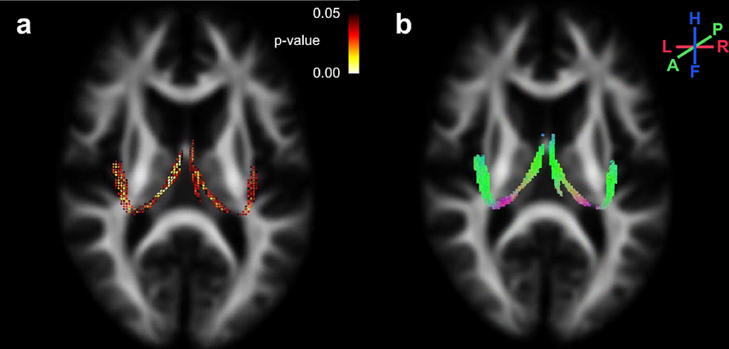 Two axial brain MRI images. The left image shows highlighted white matter regions in yellow and red where fibre measures were linked to physical performance. The right image shows the same regions as green fibre tracts running front to back through the brain.